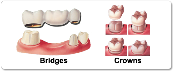 Dental Bridges & Crowns in Los Angeles