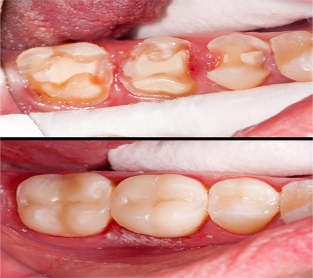 Dental Inlays & Onlays in Los Angeles
